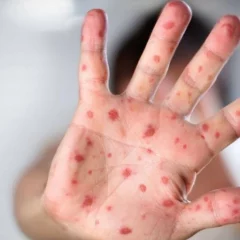 Study Identifies New Clinical Symptoms In People Infected With Monkeypox