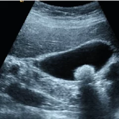 According To Study Ultrasound Can Move, Break Up Kidney Stones In Awake Patients