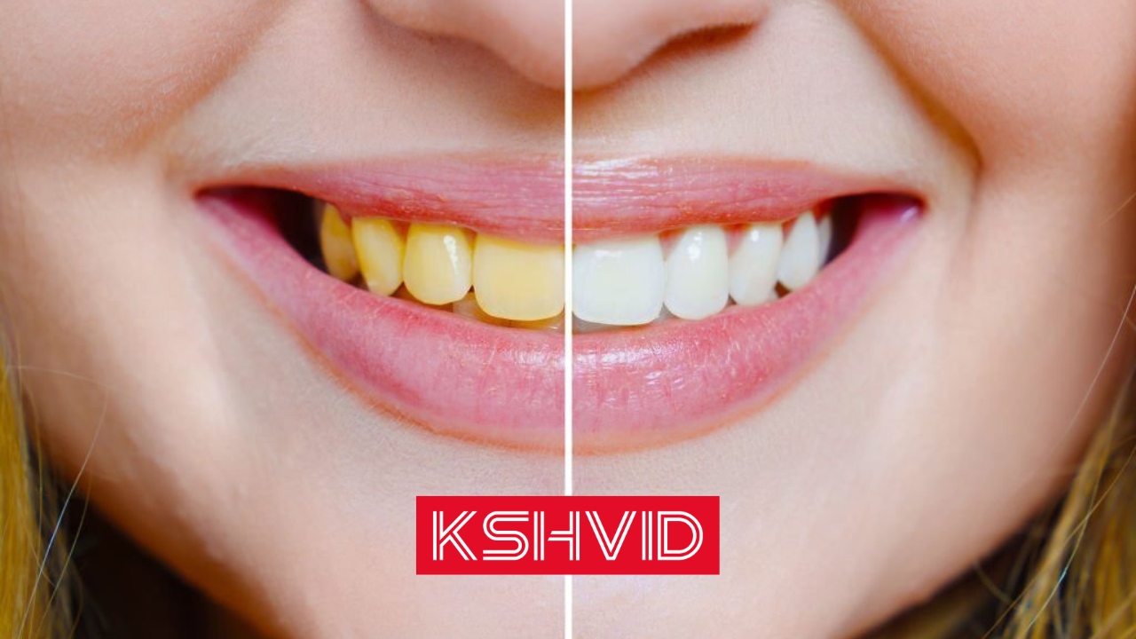 How to Remove Yellow Stains from Teeth-kshvid