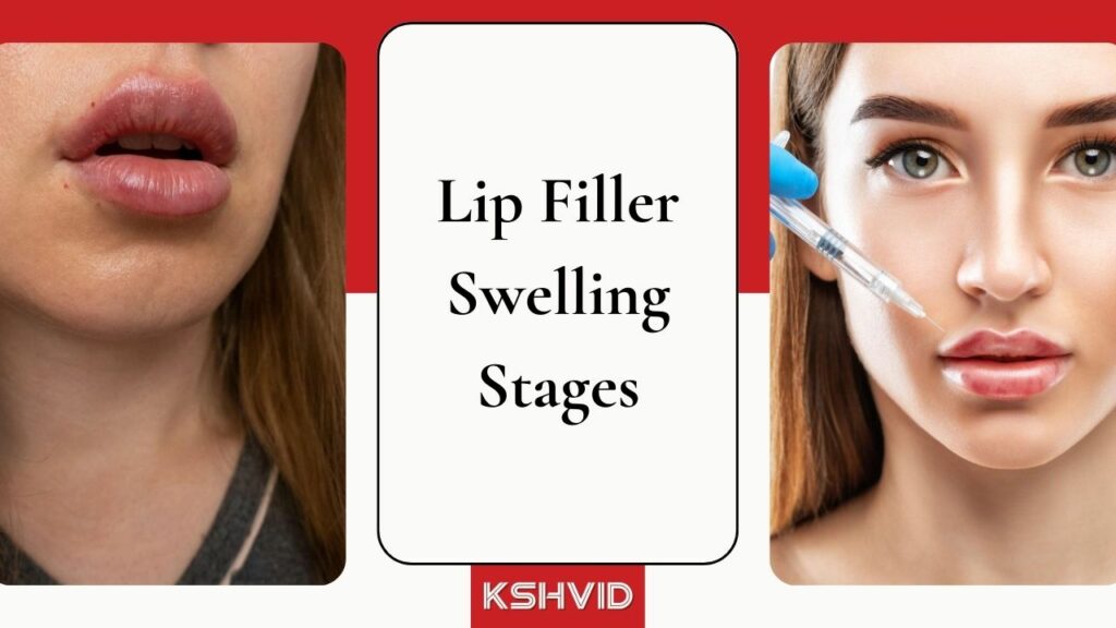 Lip Filler Swelling Stages - KSHVID