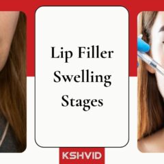 Lip Filler Swelling Stages - KSHVID